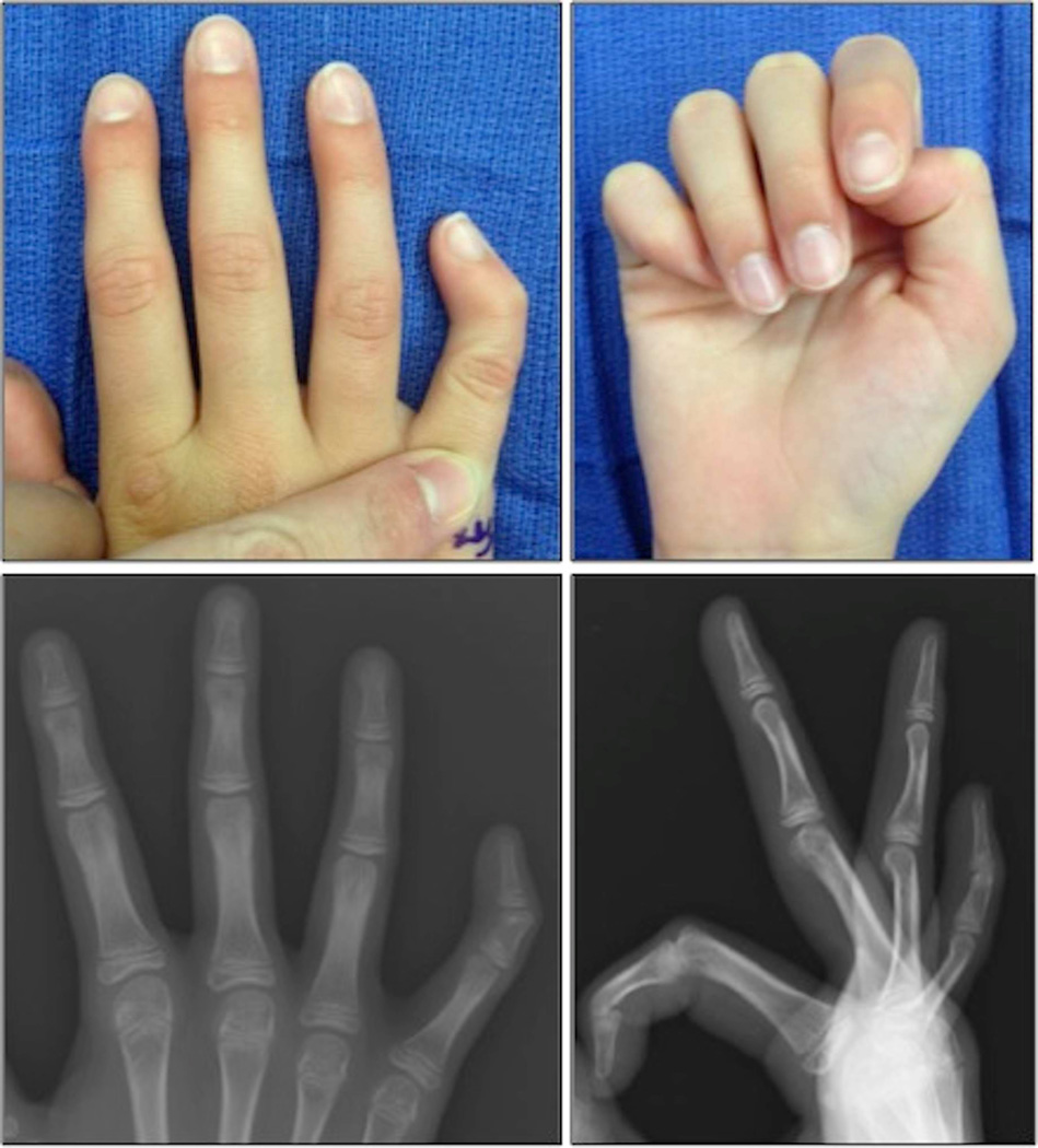 Outcomes of Opening Wedge Osteotomy to Correct Angular Deformity - Dr ...